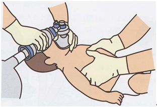 乳児のCPR２人法での胸骨圧迫