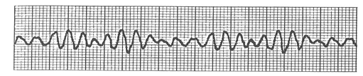 心肺停止の波形分類