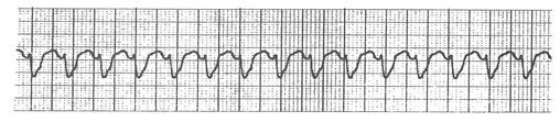 無脈性心室頻拍-単形性心室頻拍